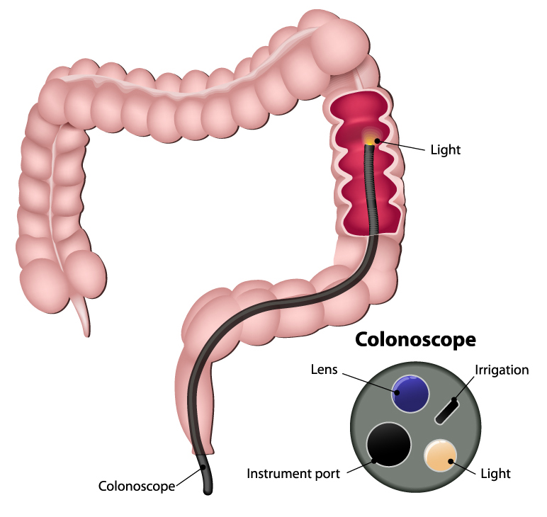 Diagram of intestine showing the colonoscopy as a black line about a third of the way into the bowel, with a light on the end. Next to it is a diagram of the colonoscopy tip showing the holes for lens, light, irrigation, and instruments.