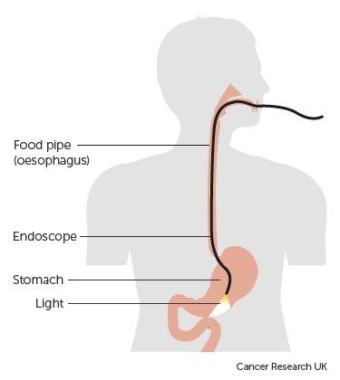 Silhouette of a person with a black line showing the endoscope going down the oesophagus and into the stomach.